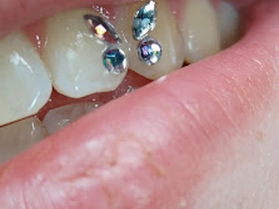 joy& smile Bleaching |Cosmetic - Smile Spa, Berlin